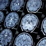 Come accelerare la diagnostica dell'epilessia