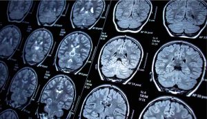 Come accelerare la diagnostica dell'epilessia